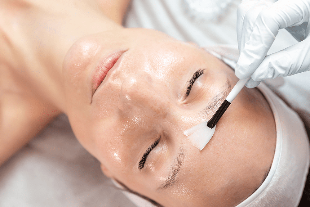 Chemical Peel Columbus