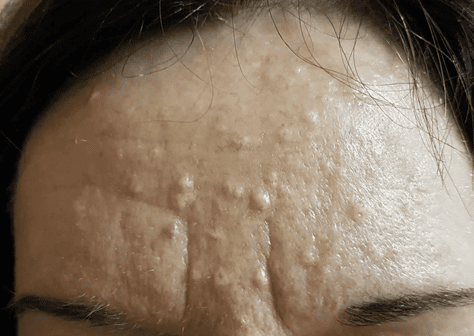 Hyperplasia Hyperplasia