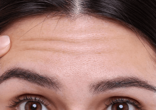 Forehead lines Forehead lines