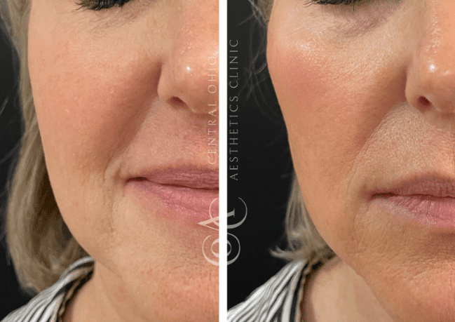 Before and after photos showing a woman's face, highlighting the effects of Botox treatment on her appearance.