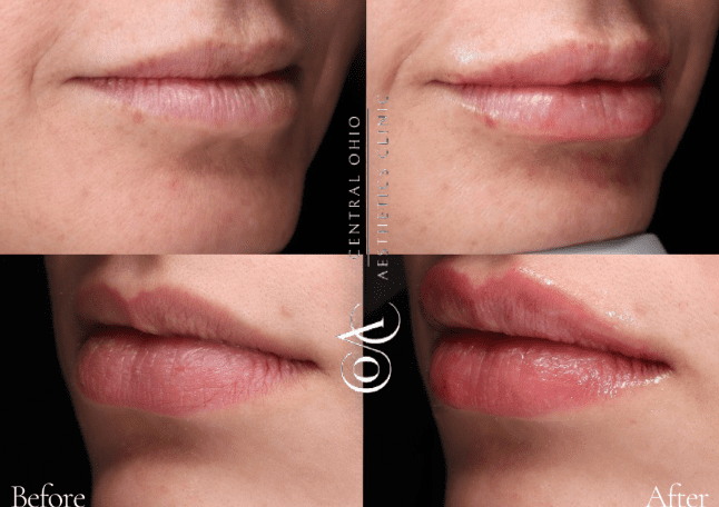Before and after photos showcasing a woman's lips, highlighting changes in shape and fullness. Before and after photos showcasing a woman's lips, highlighting changes in shape and fullness.