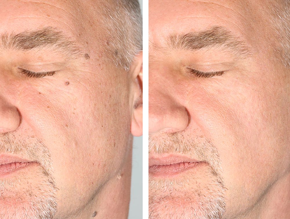 MicroLaserPeel™ Spot Treatment Columbus