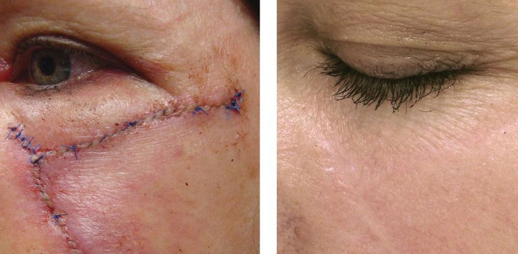 Profractional Laser™ Columbus Ohio